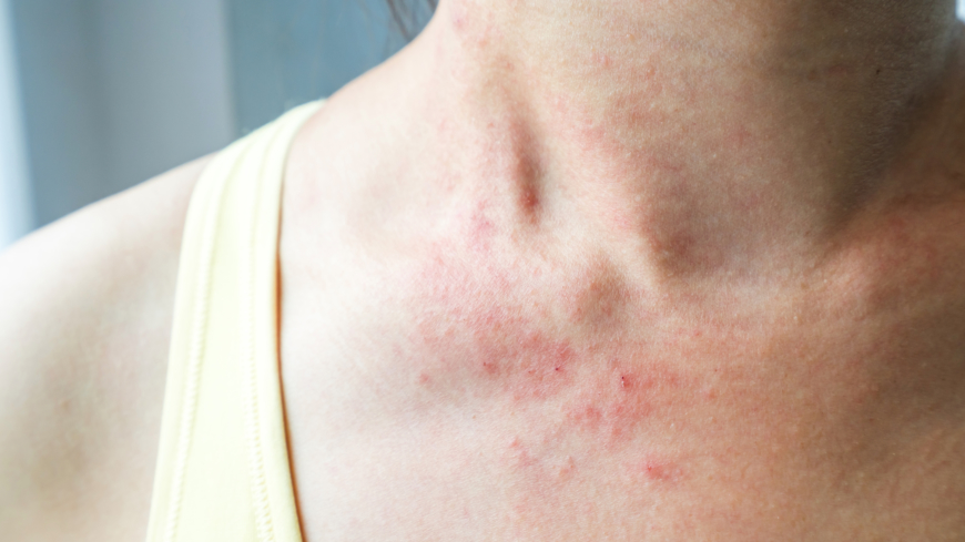 Petekier uppkommer genom att det blir en blödning från hudens minsta blodkärl. Foto: Shutterstock
